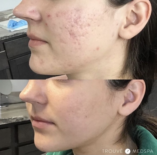 Dermapen with Mesotherapy for Treating Acne Scars and Blemishes